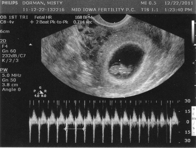 siêu âm có túi thai nhưng chưa thấy phôi thai
